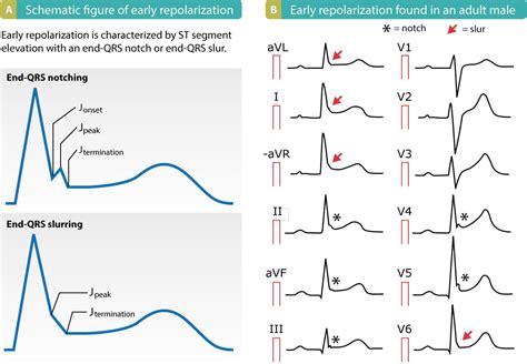 what would cause early repolarization.